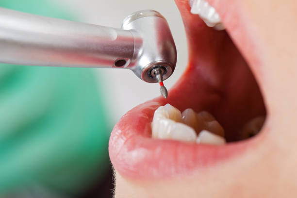 Best Chipped Tooth Repair Near Me  in Freedom, CA